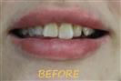 Porcelain Veneers - Cayra Clinic
