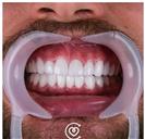 Porcelain Veneers - Cayra Clinic