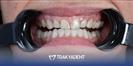 Porcelain Veneer - TrakyaDent Dental Health Center