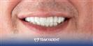 Porcelain Veneer - TrakyaDent Dental Health Center