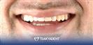 Porcelain Veneer - TrakyaDent Dental Health Center