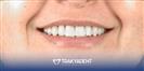 Porcelain Veneer - TrakyaDent Dental Health Center