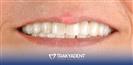 Porcelain Veneer - TrakyaDent Dental Health Center