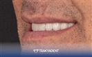 Porcelain Veneer - TrakyaDent Dental Health Center