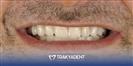 Porcelain Veneer - TrakyaDent Dental Health Center