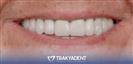 Porcelain Veneers - TrakyaDent Dental Health Center