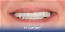 Porcelain Veneers - TrakyaDent Dental Health Center