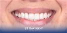 Porcelain Veneers - TrakyaDent Dental Health Center