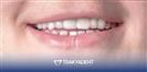 Porcelain Veneer - TrakyaDent Dental Health Center