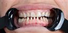 Porcelain Veneer - TrakyaDent Dental Health Center
