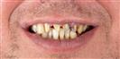 Porcelain Veneer - TrakyaDent Dental Health Center