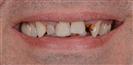 Porcelain Veneers - TrakyaDent Dental Health Center