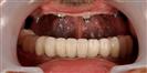 Porcelain Veneer - TrakyaDent Dental Health Center