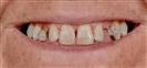 Porcelain Veneers - TrakyaDent Dental Health Center