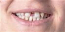 Porcelain Veneer - TrakyaDent Dental Health Center