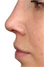 Rhinoplasty - The Nose Clinic International