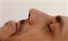 Rhinoplasty - The Nose Clinic International
