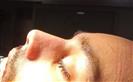 Rhinoplasty - The Nose Clinic International