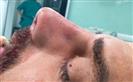 Rhinoplasty - The Nose Clinic International