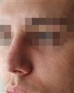 Rhinoplasty - The Nose Clinic International