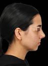 Rhinoplasty - The Nose Clinic International
