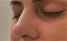 Rhinoplasty - The Nose Clinic International