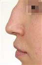 Rhinoplasty - The Nose Clinic International