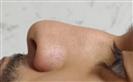 Rhinoplasty - The Nose Clinic International