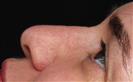 Rhinoplasty - The Nose Clinic International