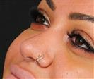 Rhinoplasty - The Nose Clinic International