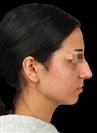 Rhinoplasty - The Nose Clinic International