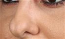 Rhinoplasty - The Nose Clinic International
