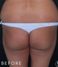 Brazilian Butt Lift - Dr. Salih Onur Basat Clinic