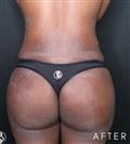 Brazilian Butt Lift - Dr. Salih Onur Basat Clinic