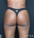 Brazilian Butt Lift - Dr. Salih Onur Basat Clinic