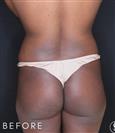 Brazilian Butt Lift - Dr. Salih Onur Basat Clinic