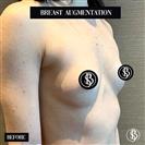 Breast Augmentation - Dr. Salih Onur Basat Clinic
