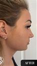 Double Chin - Vaser Liposuction - Ultrasonic Rhinoplasty - Dr. Salih Onur Basat Clinic