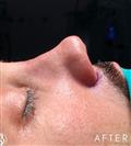 Rhinoplasty - Dr. Salih Onur Basat Clinic