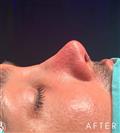 Rhinoplasty - Dr. Salih Onur Basat Clinic