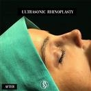 Rhinoplasty - Dr. Salih Onur Basat Clinic