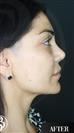 Revision Rhinoplasty - Dr. Salih Onur Basat Clinic