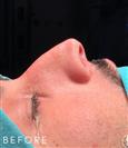 Rhinoplasty - Dr. Salih Onur Basat Clinic