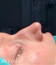 Rhinoplasty - Dr. Salih Onur Basat Clinic