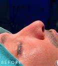 Rhinoplasty - Dr. Salih Onur Basat Clinic
