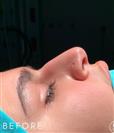 Rhinoplasty - Dr. Salih Onur Basat Clinic