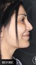 Revision Rhinoplasty - Dr. Salih Onur Basat Clinic