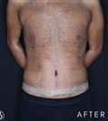 Tummy Tuck - Gynecomastia - Dr. Salih Onur Basat Clinic