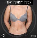 Tummy Tuck - Dr. Salih Onur Basat Clinic