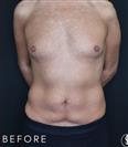 Tummy Tuck - Gynecomastia - Dr. Salih Onur Basat Clinic